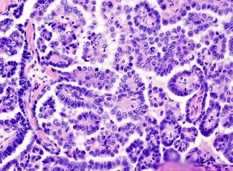 CancerRes：新研究发现帮助清除癌症干细胞的新靶标