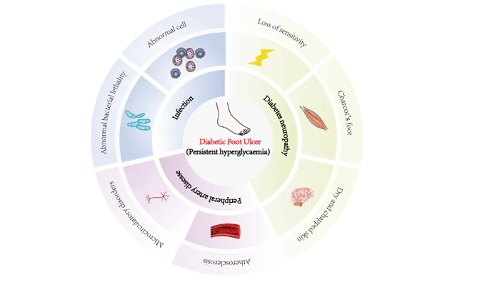 破解转化难题——糖尿病足溃疡研究